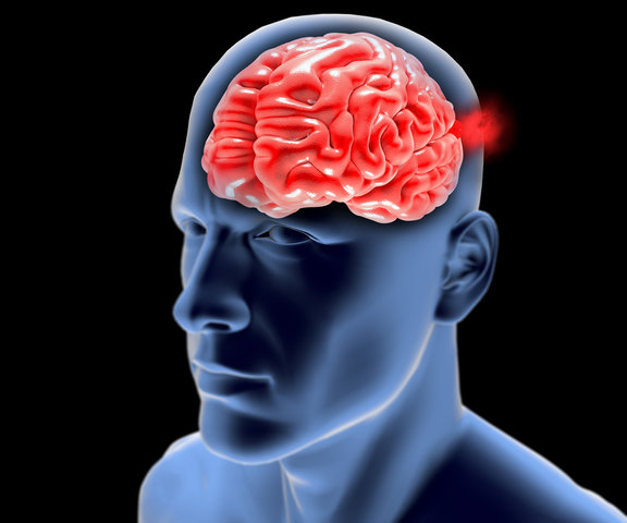 Image brain aneurysm w alpha