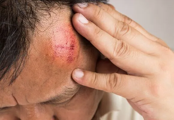 Image head trauma w alpha